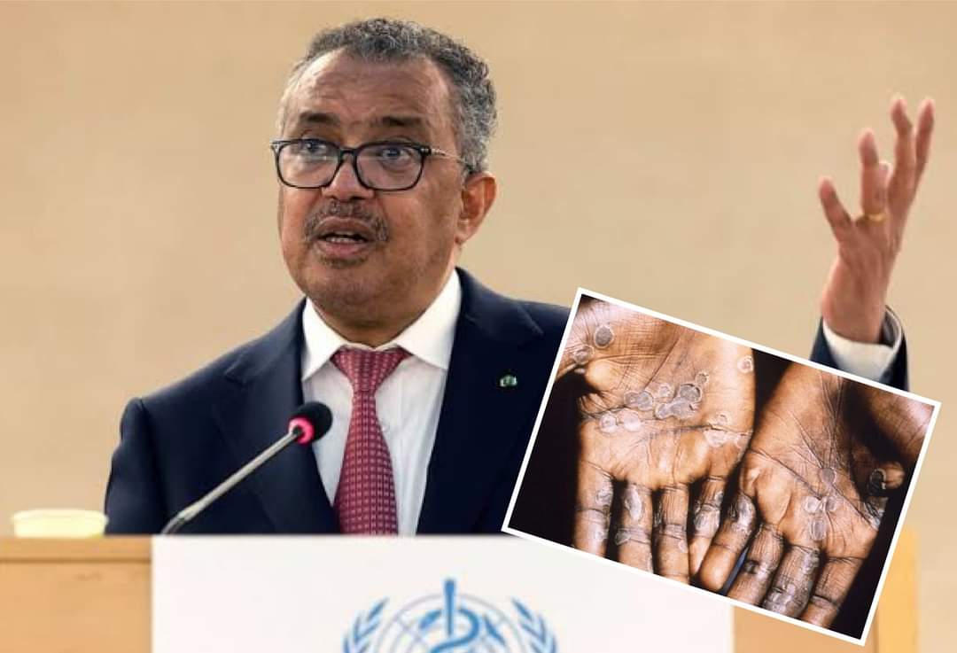 মাঙ্কিপক্স থামাতে সমকামিতায় লাগাম টানার আহ্বান বিশ্ব স্বাস্থ্য সংস্থার